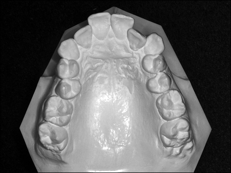 moulage ou modèle orthodontique en taille américaine